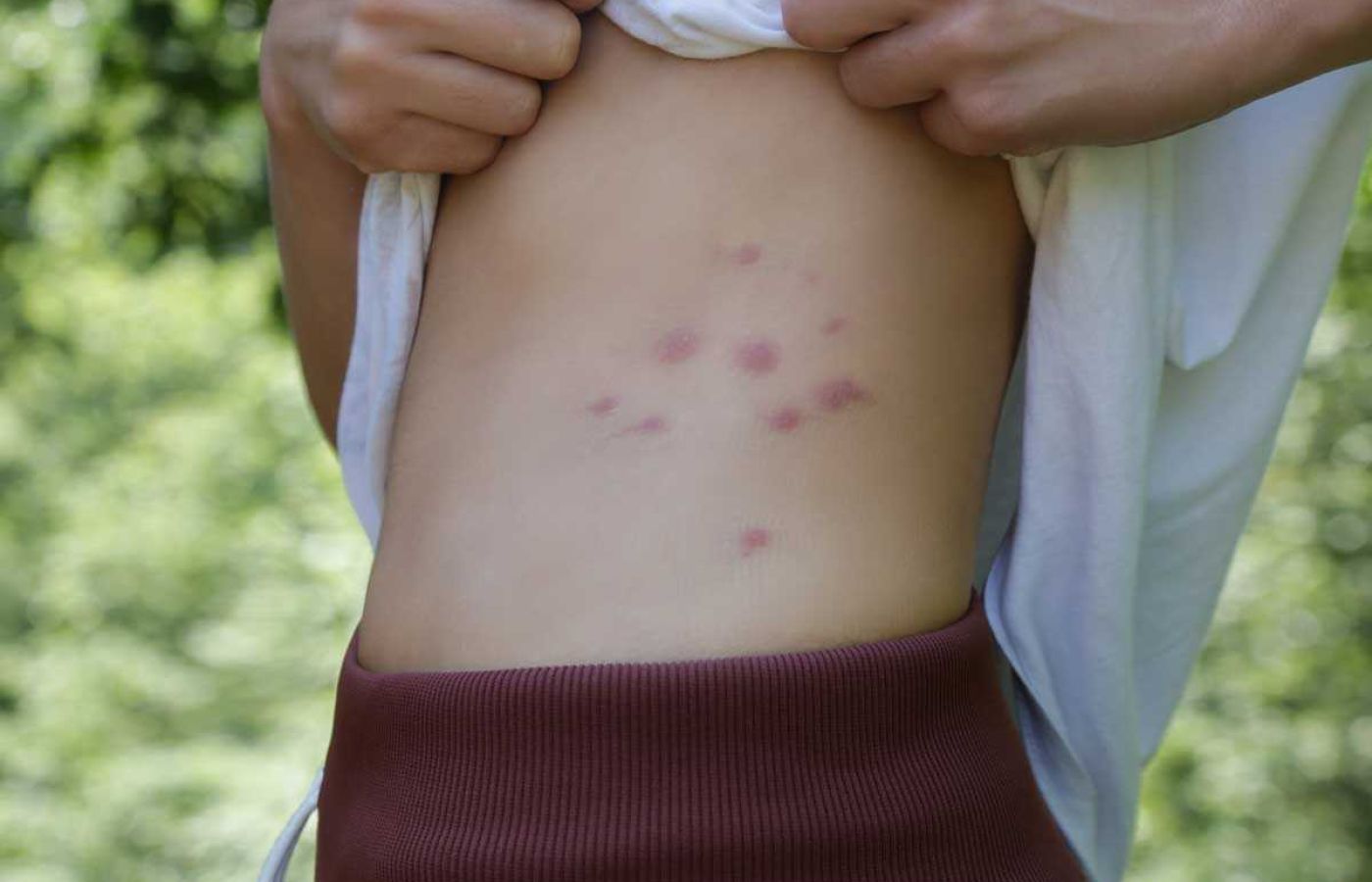 Bed bug treatment prevents allergic bites