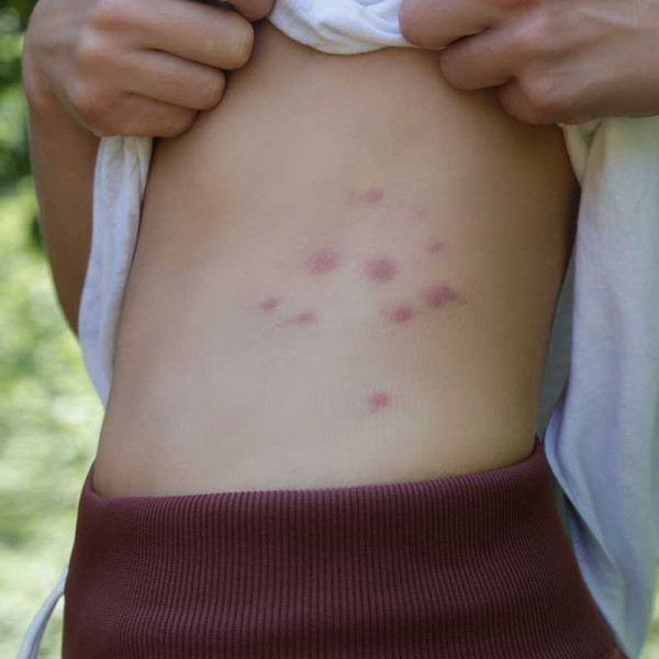 Bed bug treatment prevents allergic bites
